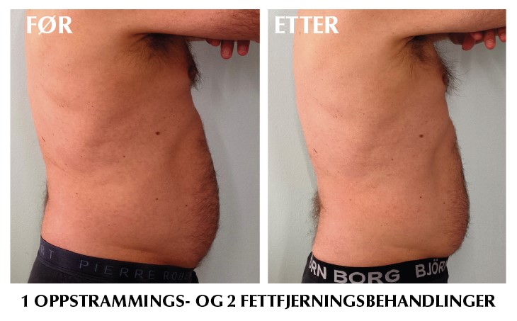 Før og etter: oppstramming og fettfjerning på mage
