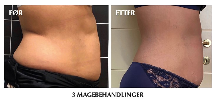 Før og etter: tre magebehandlinger med VeloraSculpt